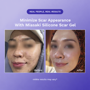 Miasaki Silicone Scar Gel