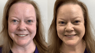 Miasaki Rosacea Corrector