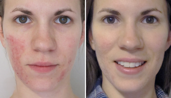 Miasaki Rosacea Corrector