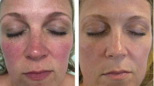 Miasaki Rosacea Corrector