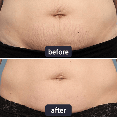 Miasaki Scar Removal Cream