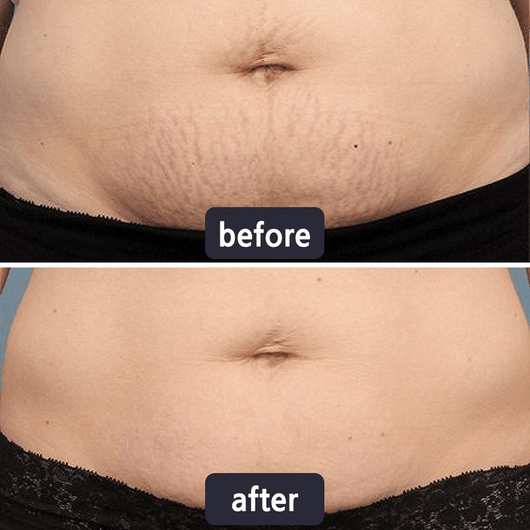 Miasaki Scar Removal Cream