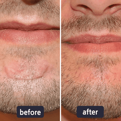Miasaki Scar Removal Cream